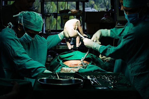 Normal-delivery-after-cesarean