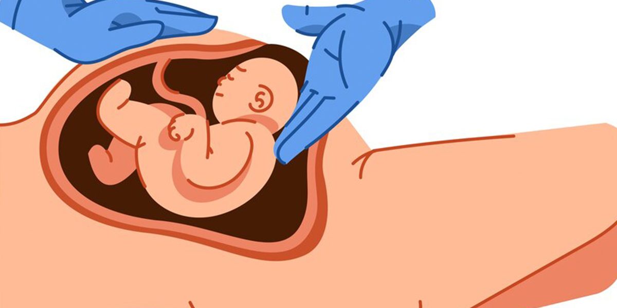 History of the cesarean section