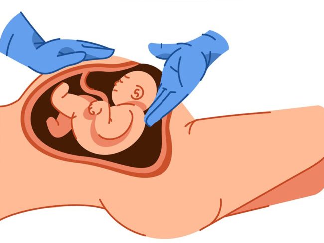 History of the cesarean section