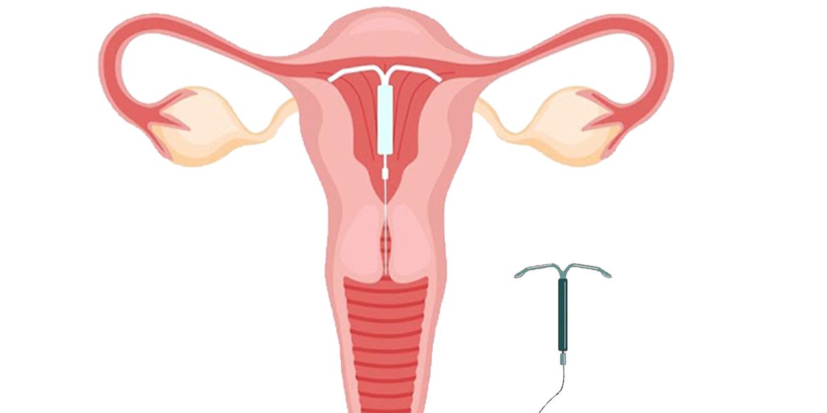 What is copper T IUD Exploring it’s benefits and key facts