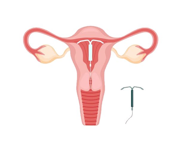 What is copper T IUD Exploring it’s benefits and key facts