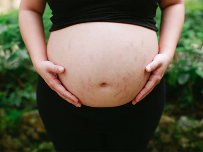 Stretch marks during pregnancy