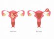 Ectopic Pregnancy