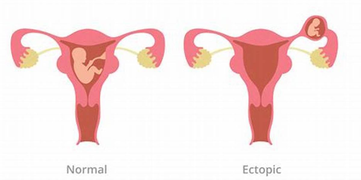 Understanding ectopic pregnancy Ectopic Pregnancy