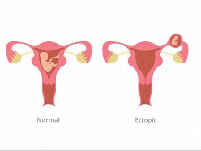Understanding ectopic pregnancy Ectopic Pregnancy