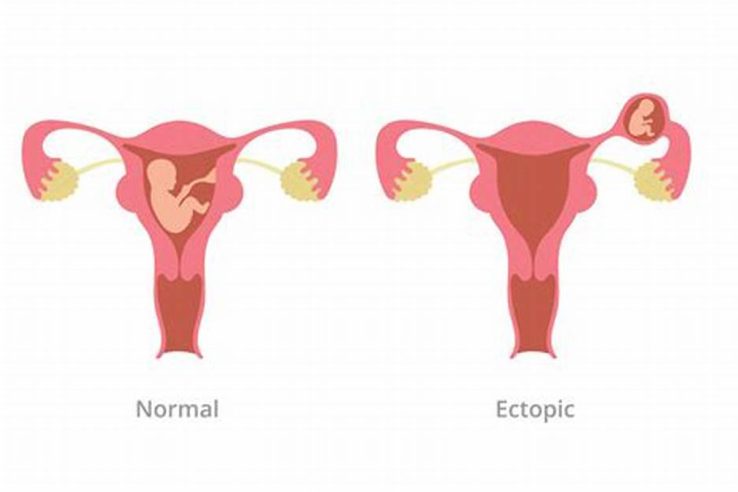 Ectopic Pregnancy